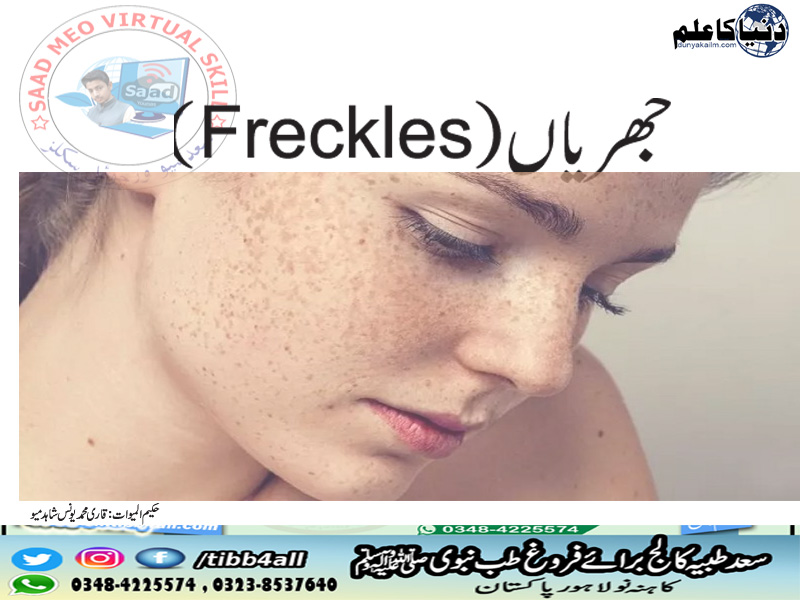 جھریاں(Freckles)