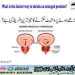 What is the fastest way to shrink an enlarged prostate