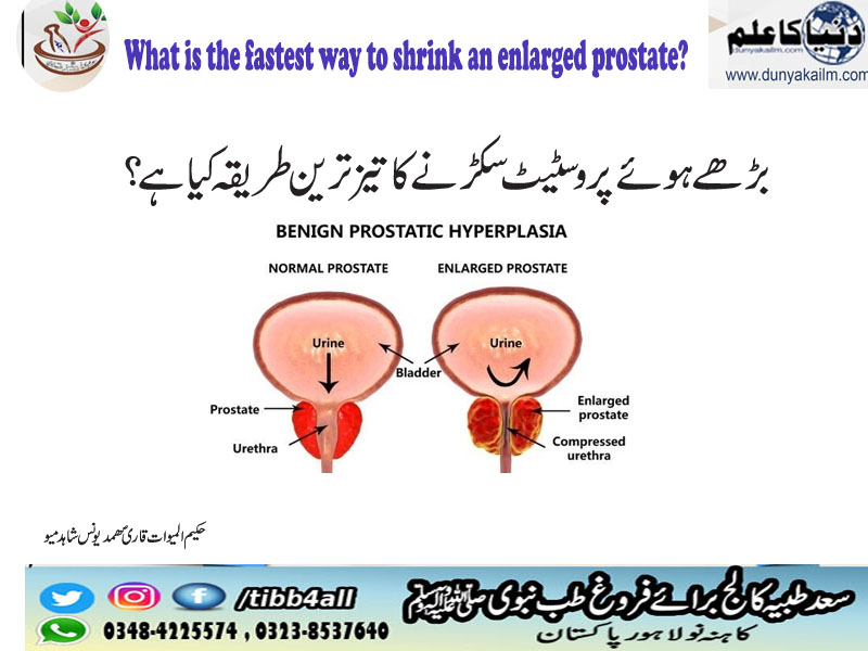 What is the fastest way to shrink an enlarged prostate